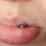 Bolla di sangue nera in bocca