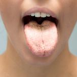 Candida gengive