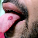 Carcinoma lingua immagini