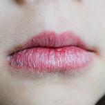 Cheilite angolare dentifricio