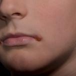 Cheilite bambini