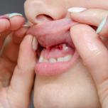 Cisti follicolare dente
