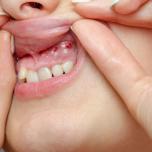 Cisti odontogene