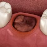 Coagulo di sangue dopo estrazione dente