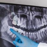 Dente del giudizio linfonodi sottomandibolari