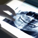 Dente giudizio nervo paralisi