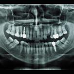 Dente in necrosi radiografia