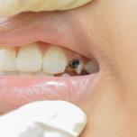 Dente marcio sotto capsula