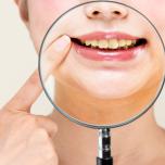 Dente marcio