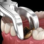 Dente necrosi puzza