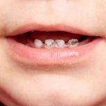 Denti neri bambini