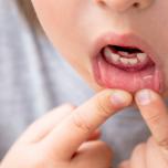 Ematoma gengivale bambino dopo caduta