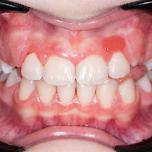 Epulide