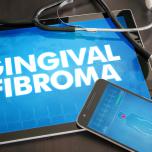 Fibroma gengivale