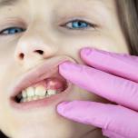 Fistola dentale