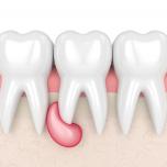 Granuloma dentale si riassorbe