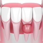 Granuloma dentale tumore