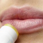 Herpes labiale