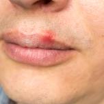 Herpes zoster in bocca