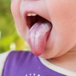 In quanto tempo si guarisce dalla candida orale