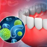 Infezione ai denti e analisi del sangue