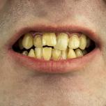 Infezione dentale trascurata