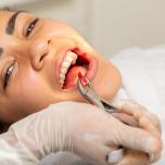Infezione dente del giudizio