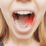 Infezione dente