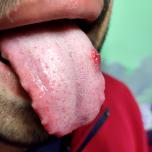 Leucoplachia a chi rivolgersi