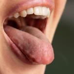 Lingua che brucia rimedi della nonna