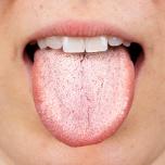Lingua villosa bianca