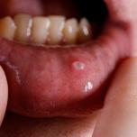 Mucocele dentista o dermatologo