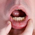 Mucocele labbro inferiore