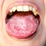 Mucosite orale immagini
