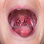 Palato infiammato vicino ai denti