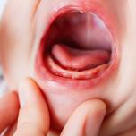 Puntino bianco gengiva neonato 