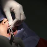 Rottura coagulo dopo estrazione dente