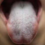 Sindrome di sjogren sintomi