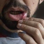 Stomatite da streptococco