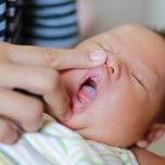 Stomatite neonato