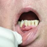 Tumore sotto i denti sintomi
