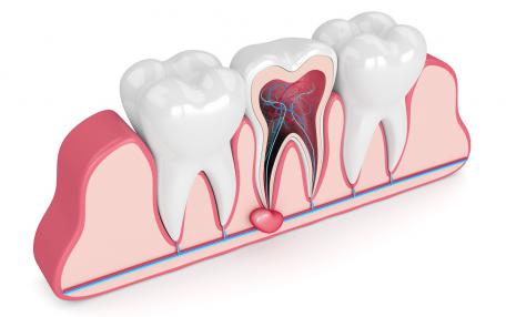 Ascesso odontogeno