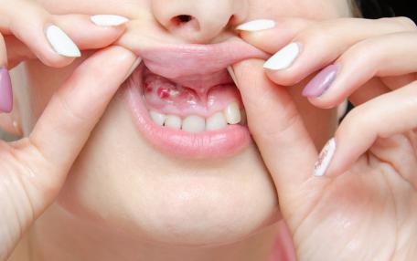 Cisti odontogene