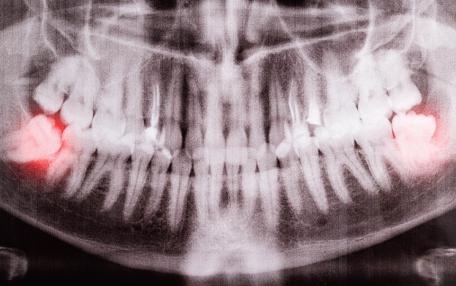 Dente del giudizio e tonsilla gonfia