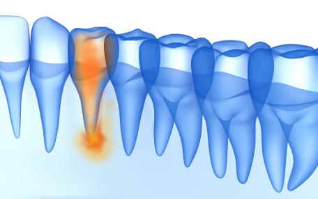 Infezione ai denti cosa provoca