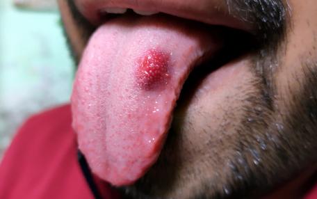 Leucoplachia verrucosa
