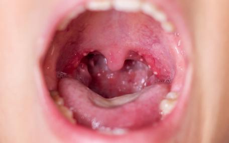 Palato infiammato vicino ai denti