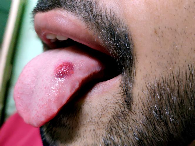 Carcinoma lingua immagini Carcinoma lingua immagini