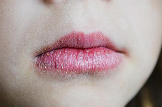 Cheilite angolare dentifricio Cheilite angolare dentifricio
