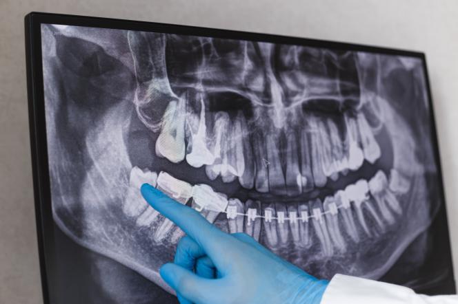 Dente del giudizio linfonodi sottomandibolari Dente del giudizio linfonodi sottomandibolari